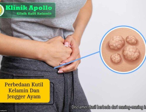 Perbedaan Kutil Kelamin dan Jengger Ayam: Ini Faktanya