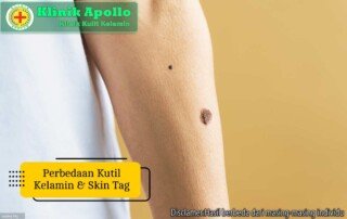 Ilustrasi Perbedaan Kutil Kelamin dan Skin Tag.