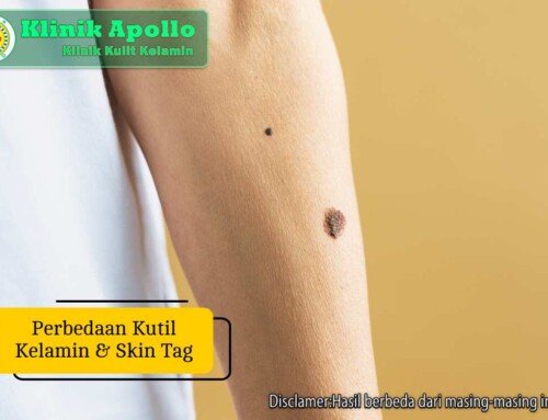 Kenali Perbedaan Kutil Kelamin dan Skin Tag pada Kulit