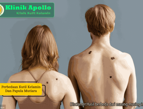 Awas Keliru! Ini Bedanya Kutil Kelamin dan Papula Mutiara