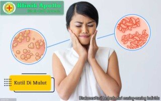 Ilustrasi Kutil di Mulut.