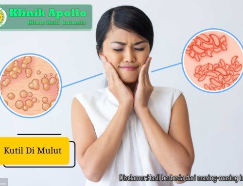Kenali Ciri-ciri Kutil di Mulut Serta Cara Mengobatinya