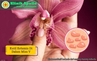 Ilustrasi Kutil Kelamin di Dalam Miss V.