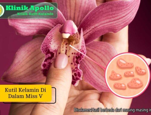 Kutil Kelamin di Dalam Miss V: Ciri-ciri dan Pengobatan