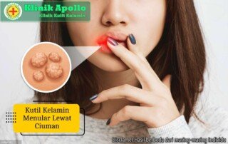 Ilustrasi Kutil Kelamin Menular Lewat Ciuman.
