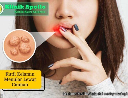 Kutil Kelamin Menular Lewat Ciuman? Ini Faktanya