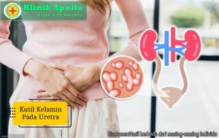 Ilustrasi Kutil Kelamin pada Uretra.