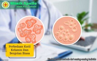Ilustrasi Perbedaan Kutil Kelamin dan Benjolan Biasa.