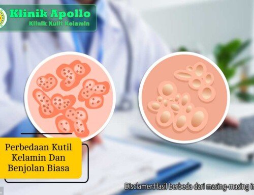 Perbedaan Kutil Kelamin dan Benjolan Biasa, Cek Disini