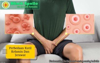 Ilustrasi Perbedaan Kutil Kelamin dan Jerawat.