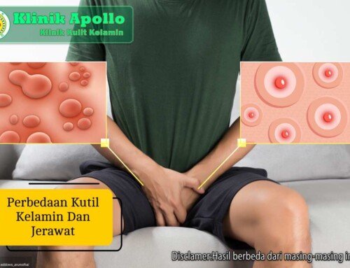 Perbedaan Kutil Kelamin dan Jerawat: Kenali Ciri-Cirinya