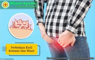 Ilustrasi Perbedaan Kutil Kelamin dan Wasir.